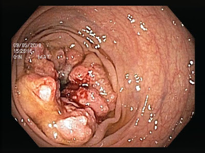圖片顯示大腸鏡下大腸癌的外觀